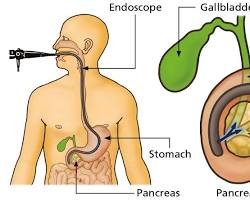 ERCP Test – Procedure, Purpose, Risks, Results & Complete Guide 2 images